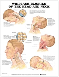 Whiplash Injuries of the Head and Neck ...